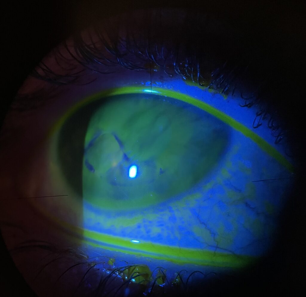 Imagen de córnea con Alteración de la superficie corneal.