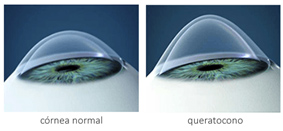 Diferencias de forma de las corneas según patología